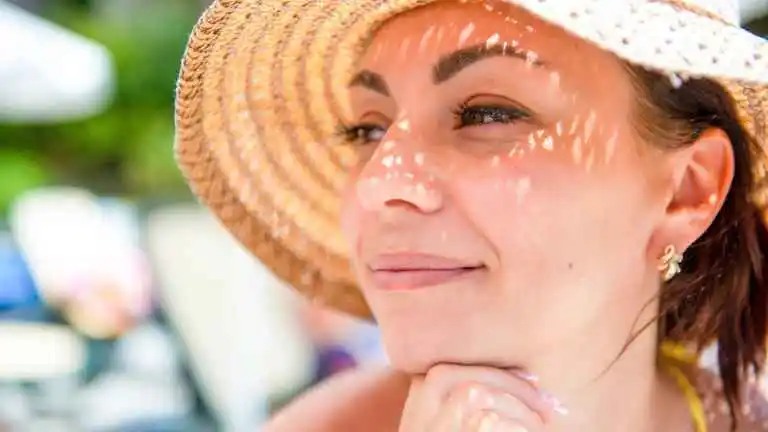 Melasma: Como Evitar que as Manchas Escureçam no Verão